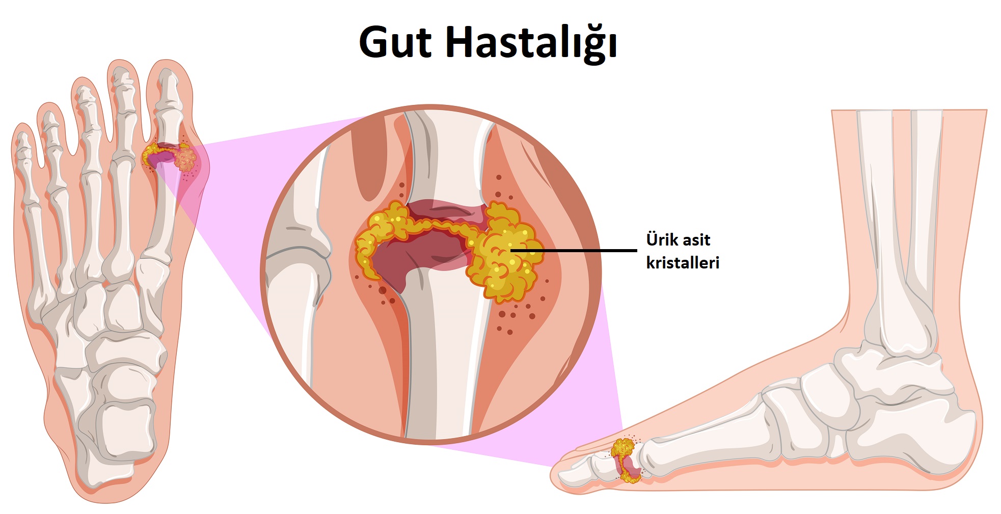 Gut hastalığı nedir? Beslenme Tedavisi nasıl olmalı?